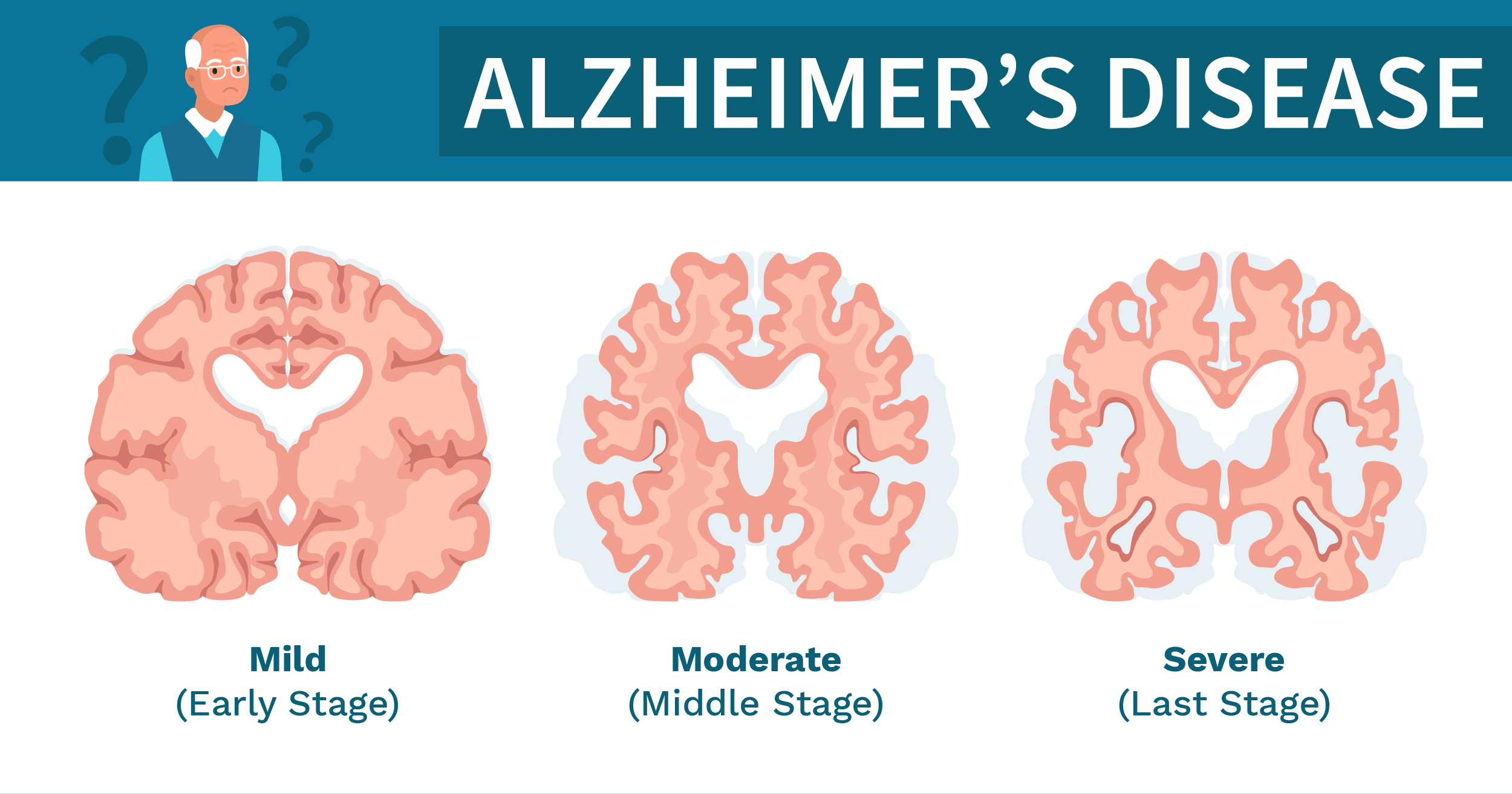 Understanding the Different Stages of Alzheimer's Progression - Shinon ...